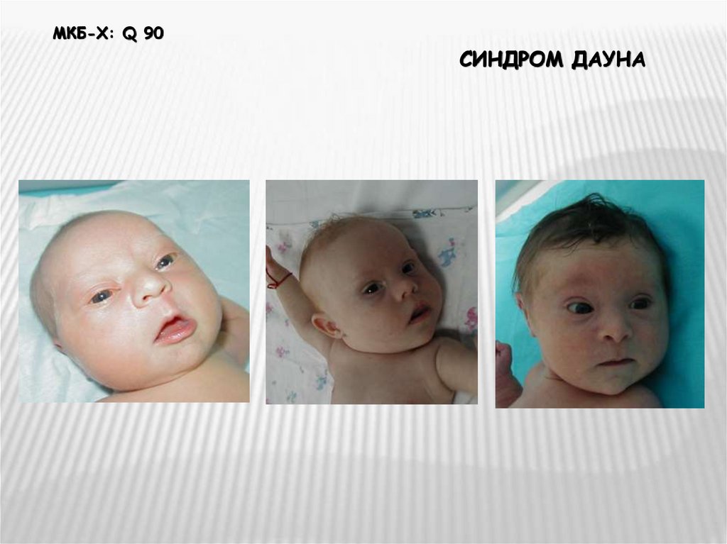 Дети Дауны Фото Новорожденных Признаки Фото