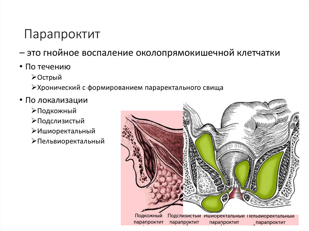 Клиническая картина парапроктита