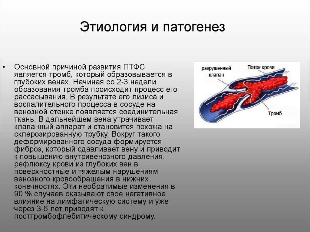 Посттромбофлебитический синдром презентация - 84 фото