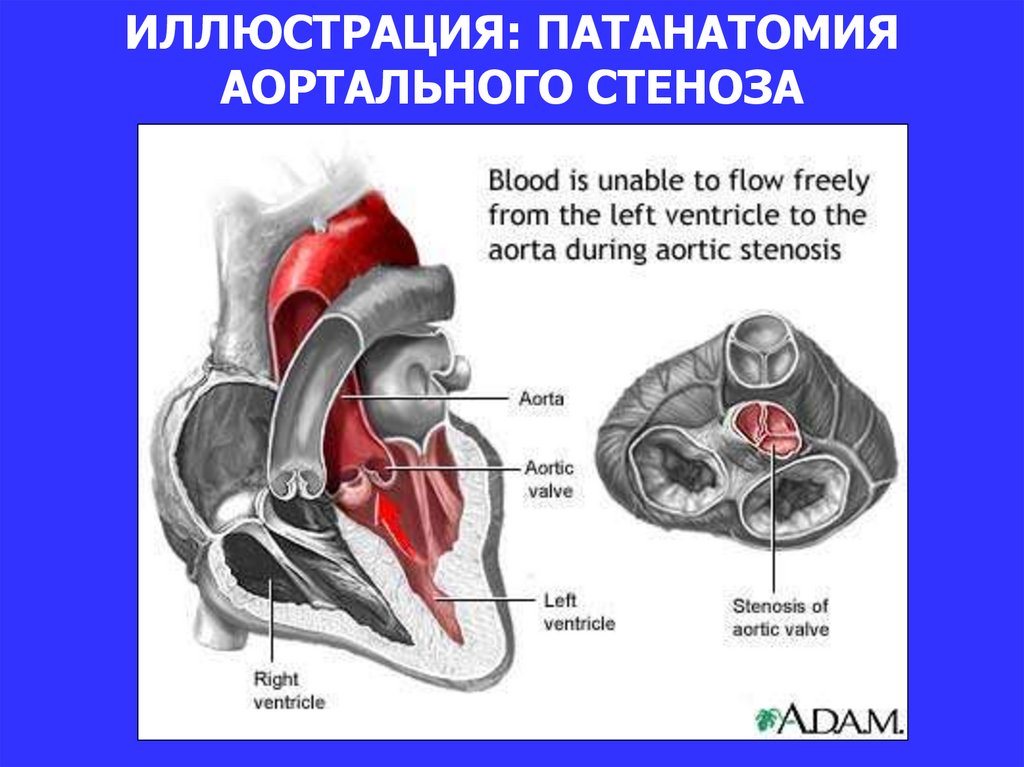 Аортальный стеноз презентация