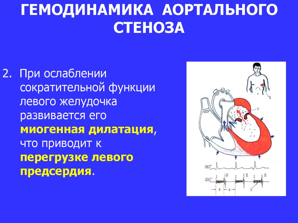 Схема гемодинамики при пороках сердца