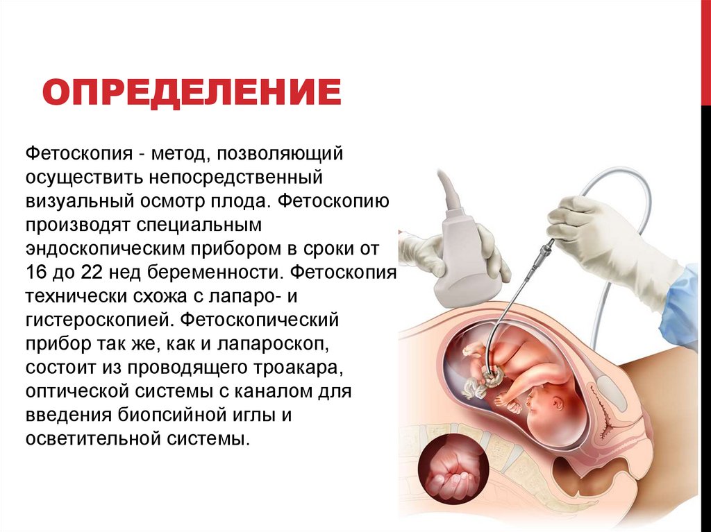 Фетоскопия - презентация онлайн