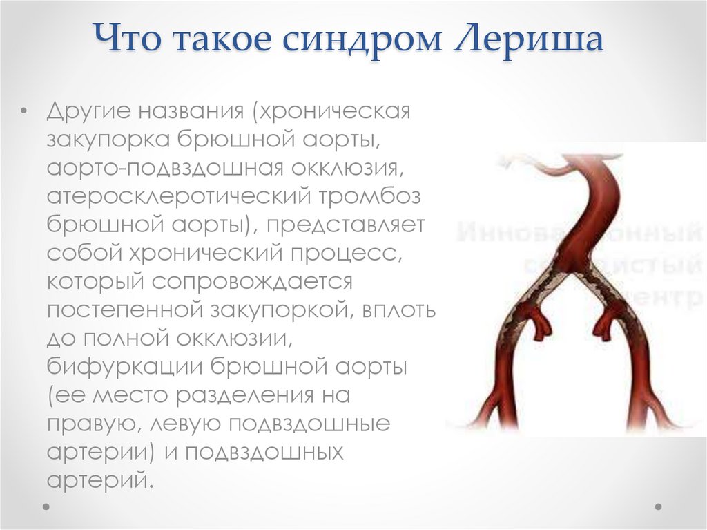 Синдром Лериша - online presentation