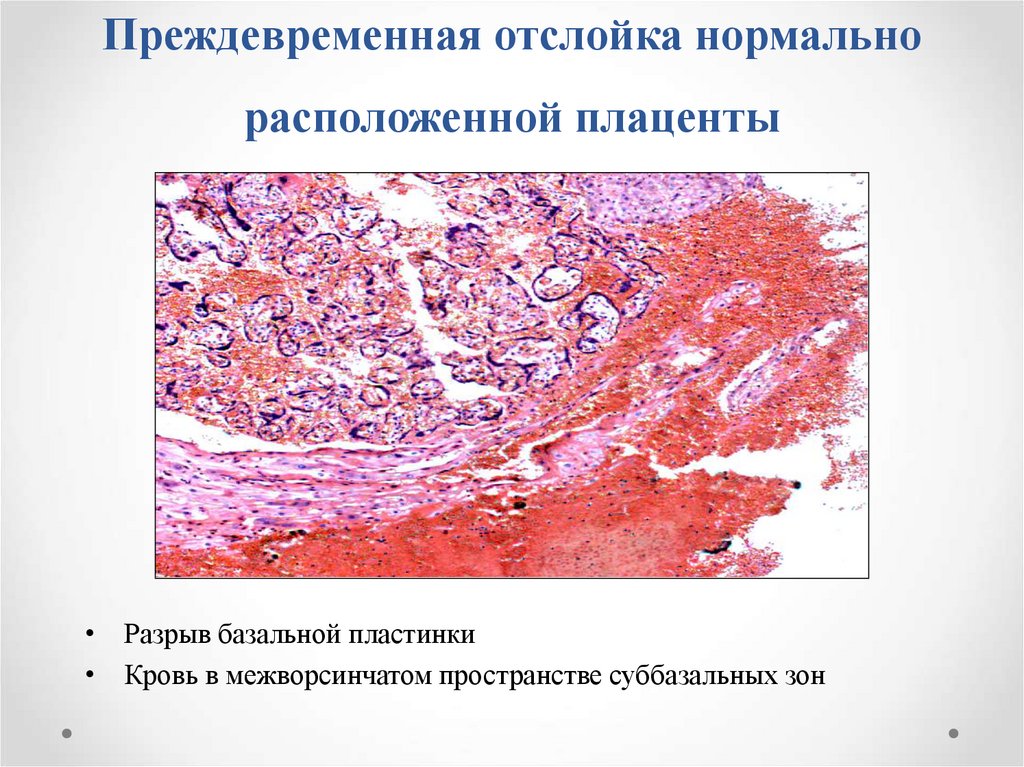 Преждевременная отслойка плаценты презентация