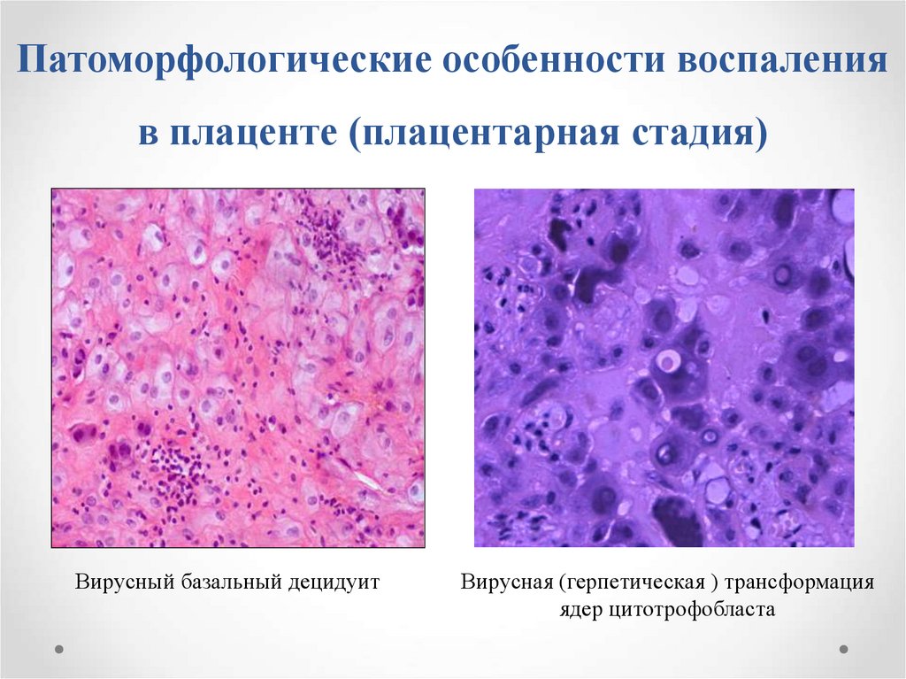 Патология последа презентация