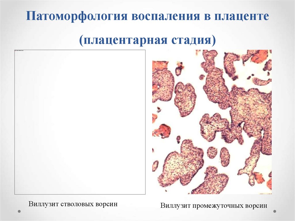 Патология последа презентация