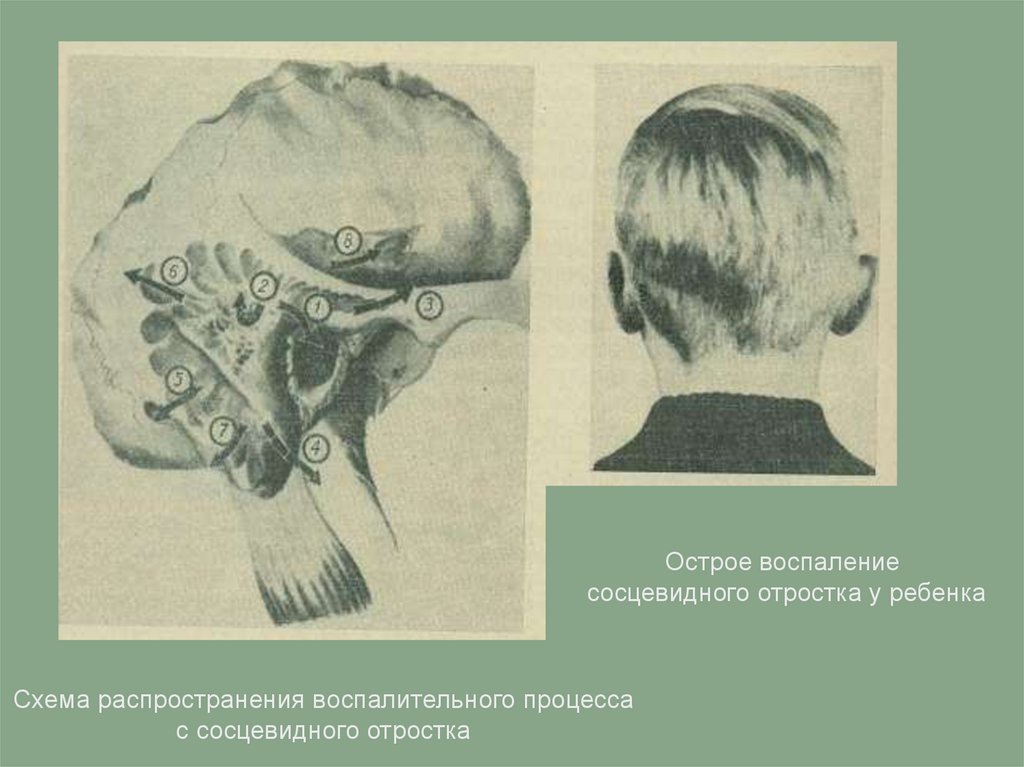 Воздухоносные ячейки сосцевидного отростка. Сосцевидный отросток височной кости. Воспалительные изменения сосцевидных отростков. Височная кость сосцевидный отросток. Пневматический тип сосцевидного отростка.