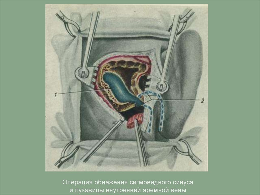 Операция на среднем ухе