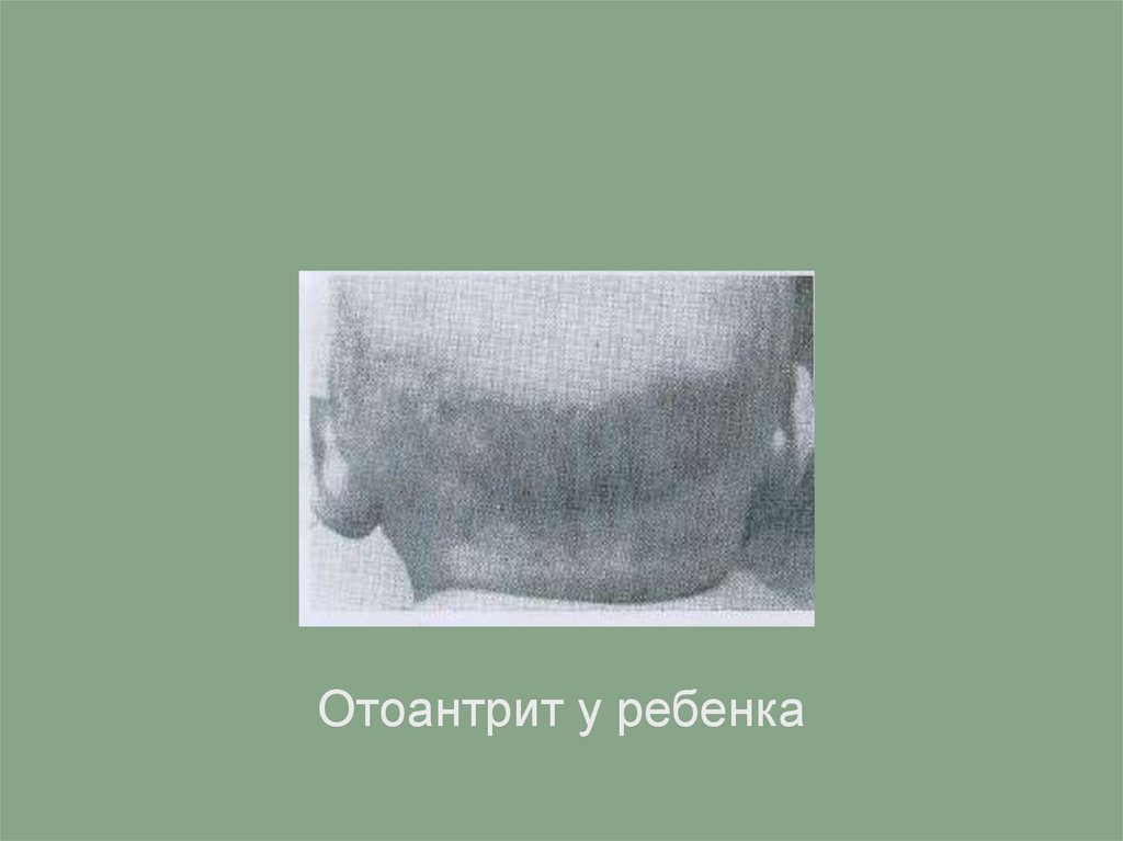 Гнойный средний отит - презентация онлайн