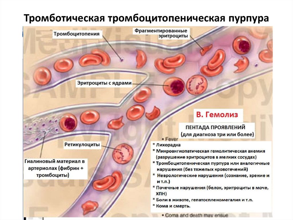 Идиопатическая тромбоцитопеническая пурпура картинки