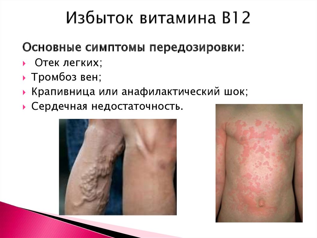 Избыток витамина B12