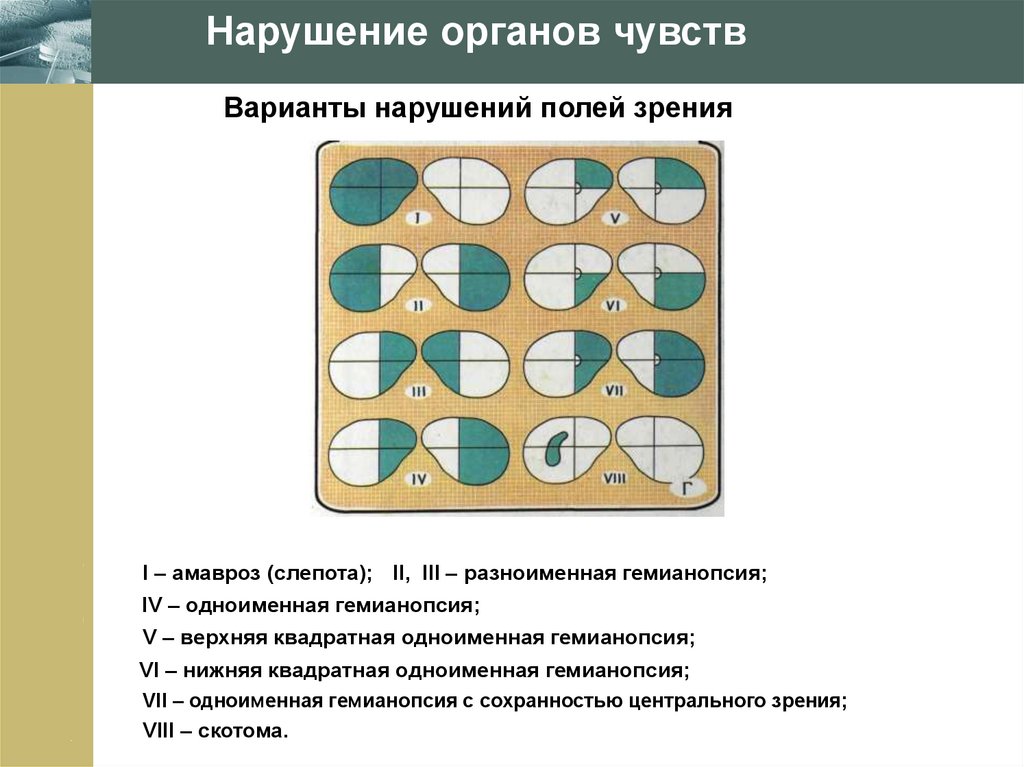 Выпадение полей зрения. Нарушение полей зрения. Нарушения зрительных полей. Поля зрения патология. Дефекты поля зрения.