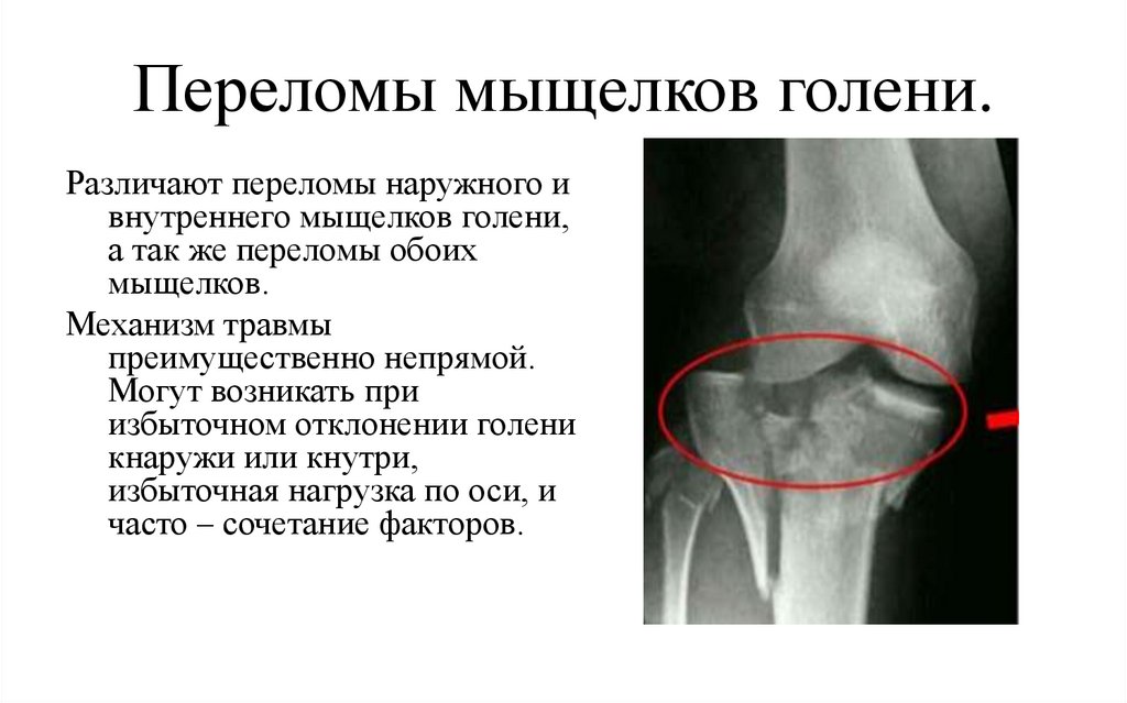 Мыщелок ноги. Перелом внутреннего мыщелка большеберцовой кости рентген. Компрессионный перелом наружного мыщелка большеберцовой кости. Оскольчатый перелом мыщелка берцовой кости. Импрессионный перелом внутреннего мыщелка бедренной кости.