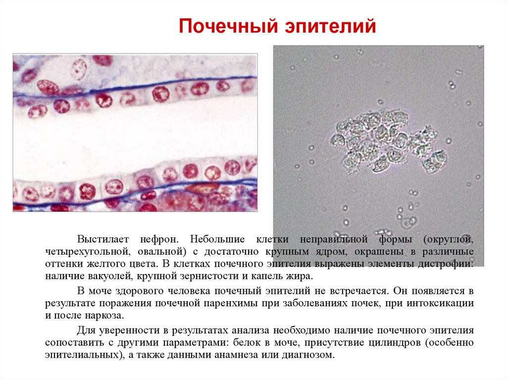 Повышенный эпителий в моче у мужчин. Морфология почечного эпителия. ОАМ клетки почечного эпителия. Микроскопия мочи почечный эпителий. Цилиндрический почечный эпителий.