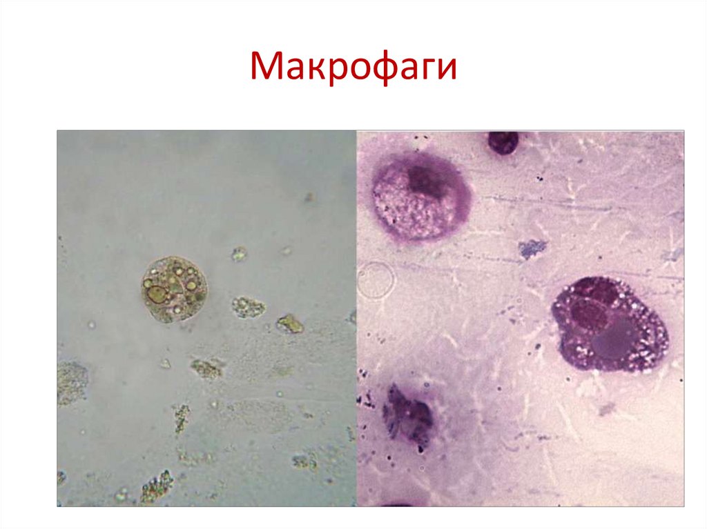 Эритроциты макрофаги. Пенистые макрофаги гистология. Макрофаги спермограмма микроскопия. Макрофаги цитология. Цитология атлас Макрофаг.