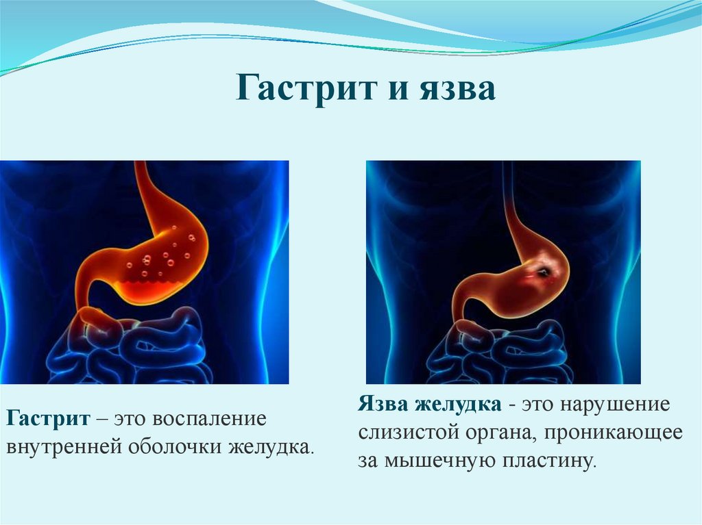 Проект на тему гастрит