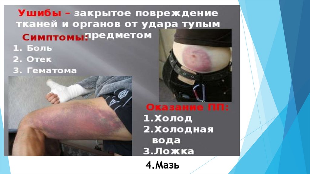 Оказание первой помощи при ушибах, вывихах суставов и переломах костей ...
