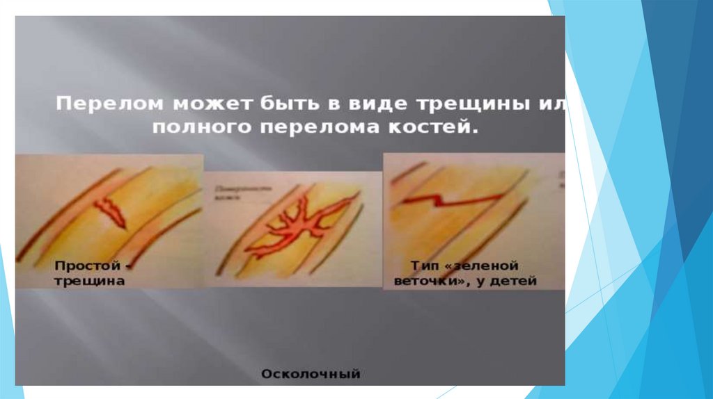 Оказание первой помощи при ушибах, вывихах суставов и переломах костей ...