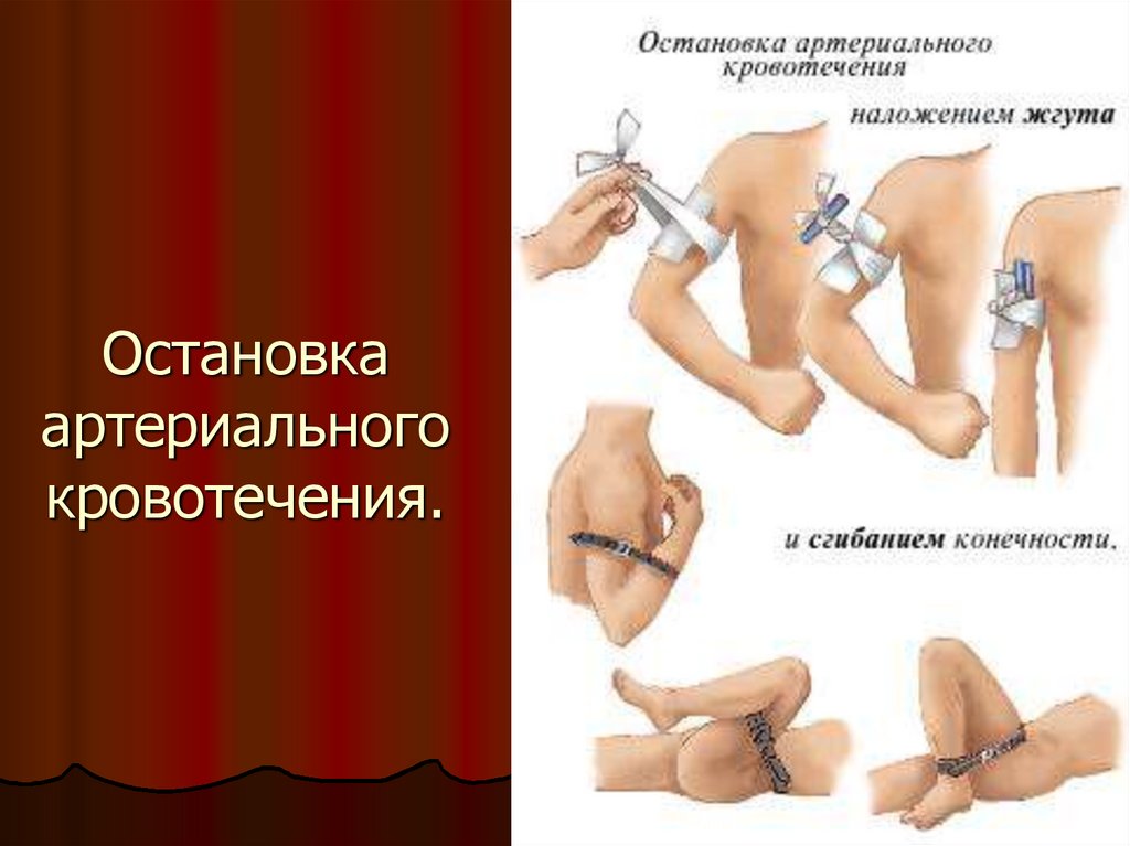 Способы остановки кровотечений презентация