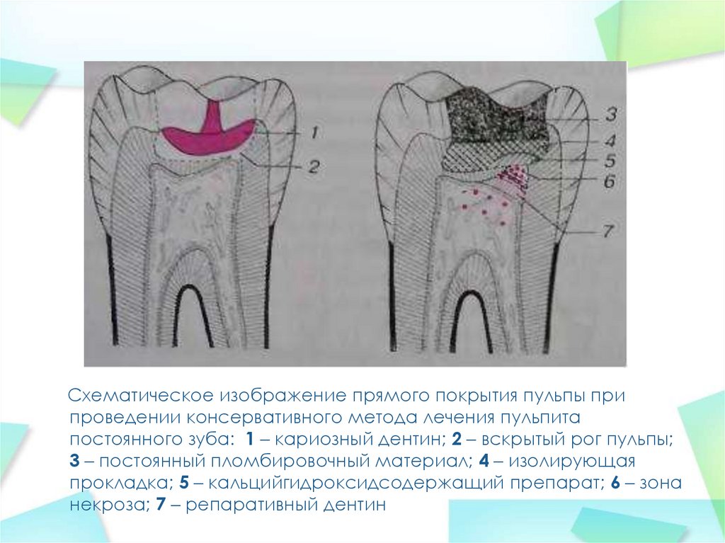 Схема наложения лечебных прокладок