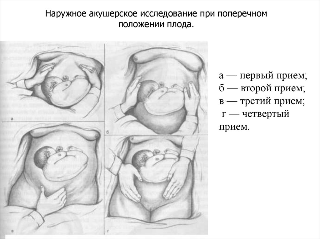 Ребенок расположен справа. Продольное положение плода при беременности в 30 недель. Продольное положение плода при беременности в 30 недель беременности. Продольное положение плода при беременности в 32 недели. Положение плода продольное предлежание головное.
