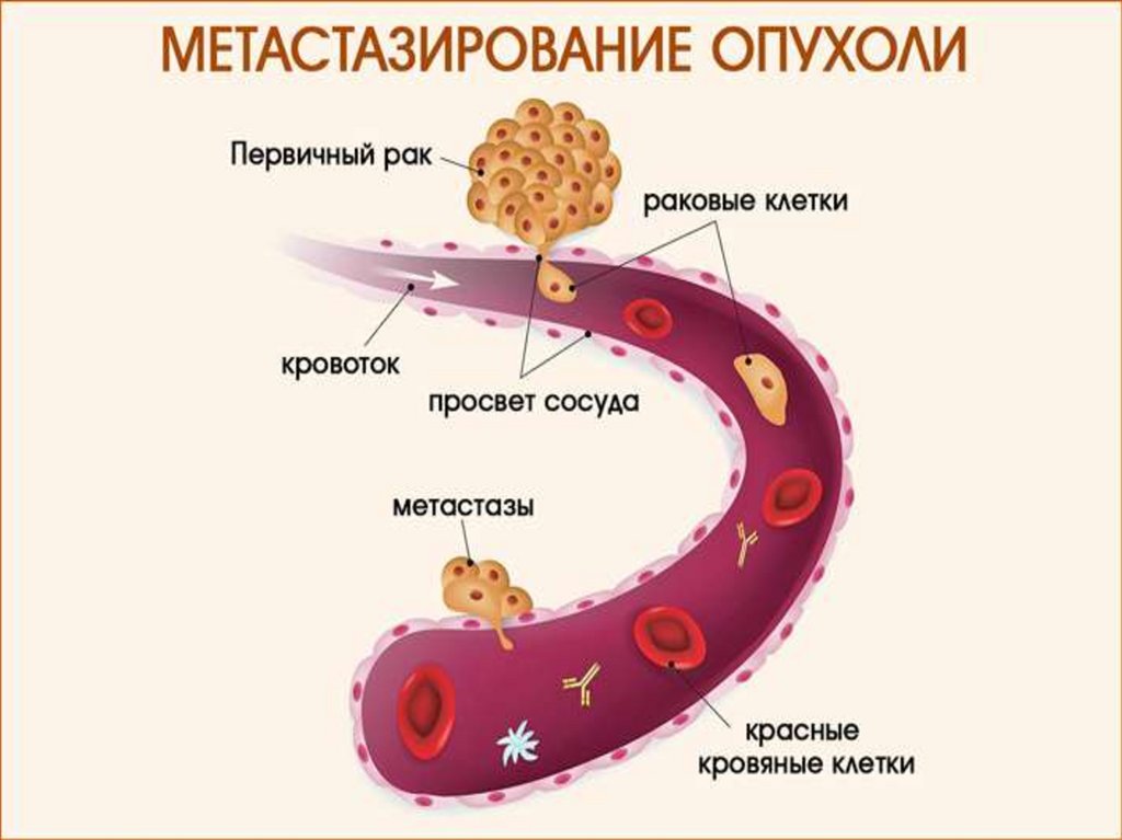 Схема развития опухолей