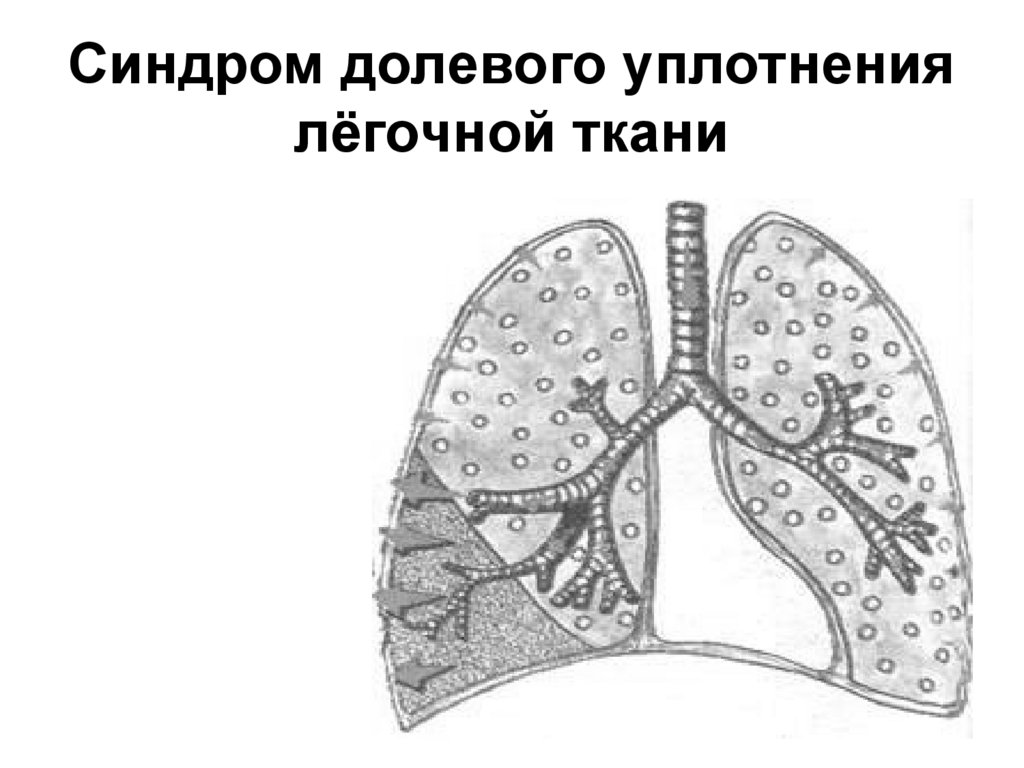 Уплотнение легочной ткани. Синдром воспалительного уплотнения легочной ткани. Синдром долевого уплотнения легочной ткани. Синдром массивного уплотнения легочной ткани. Синдром уплотнения легочной ткани (крупозная и очаговая пневмонии.