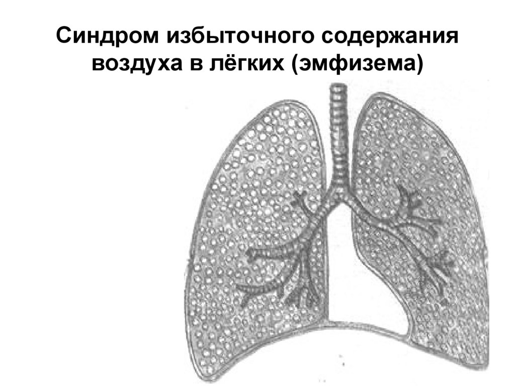 Синдром повышенной воздушности легочной. Синдром эмфиземы легкого. Эмфизема легких пропедевтика. Синдром эмфиземы пропедевтика. Синдром избыточного содержания воздуха в лёгких (эмфизема).