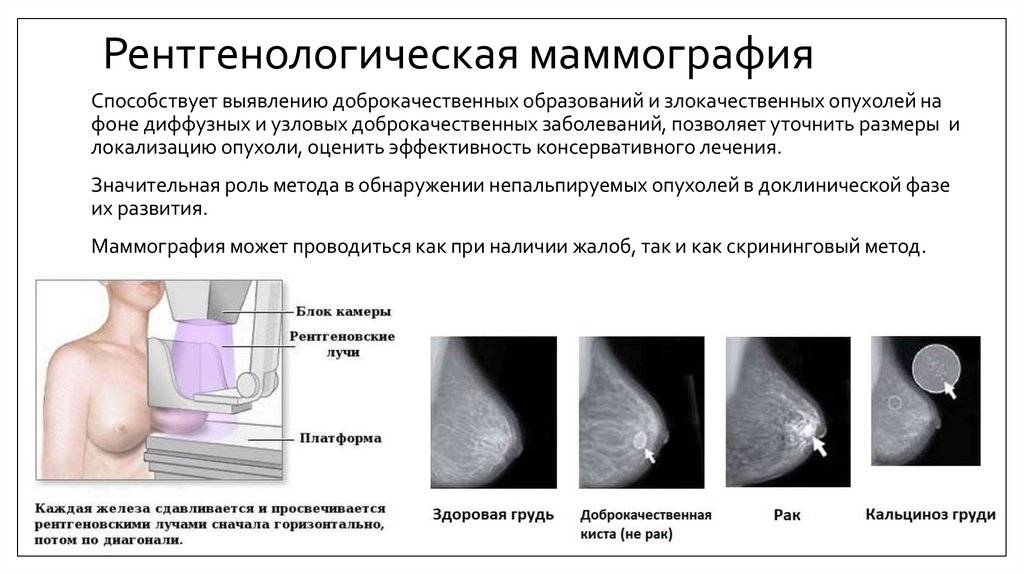 Анализ маммографии. Рентгенологическая маммография. Мамаогра. Маммография метод исследования.
