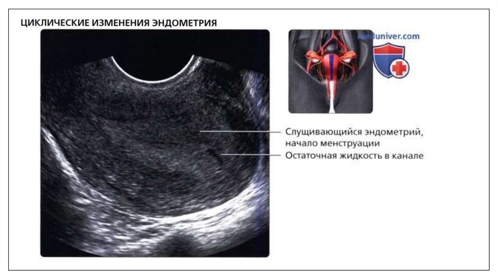 Эндометрий 24. Ультразвуковая анатомия матки. УЗИ матки перед месячными.
