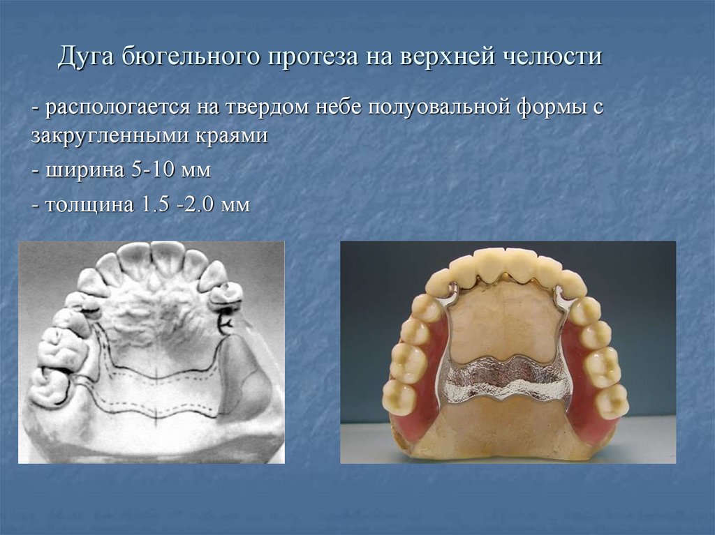 Бюгельные протезы презентация