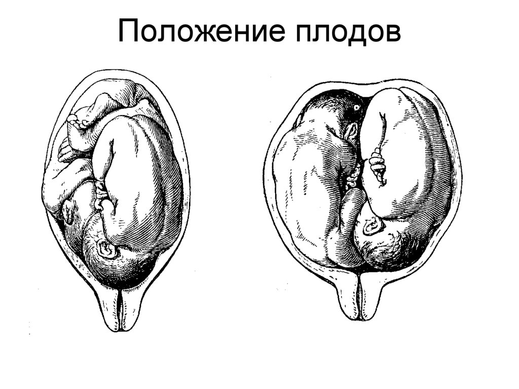 1 и 2 позиция плода. Расположение плода растений. Положение плодов при многоплодной беременности.