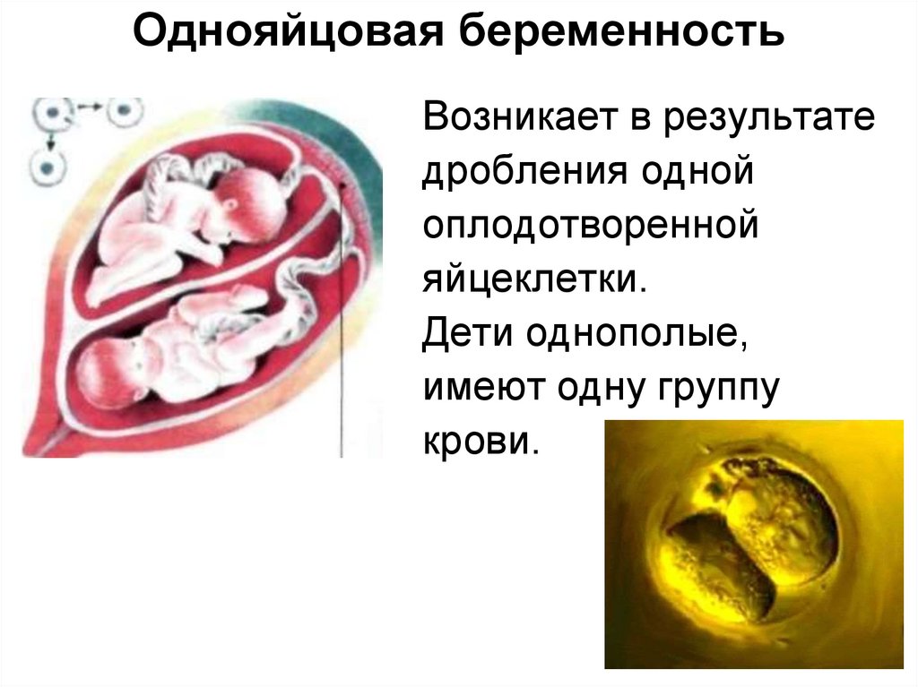 Многоплодная беременность презентация