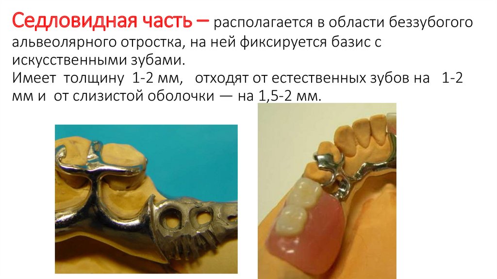 Бюгельные протезы презентация