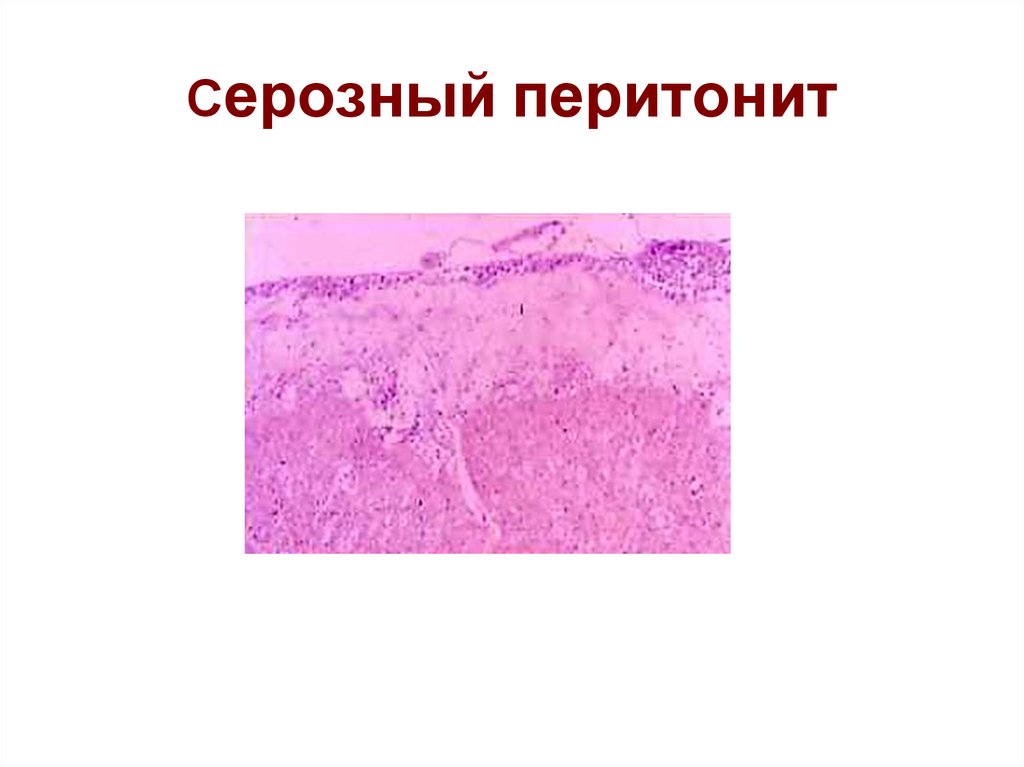 Перитонит патогенез