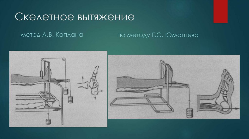 Пяточное вытяжение. Скелетное вытяжение по Юмашеву. Скелетное вытяжение по Каплану. Скелетное вытяжение при переломе лопатки. Скелетное вытяжение пяточной кости.