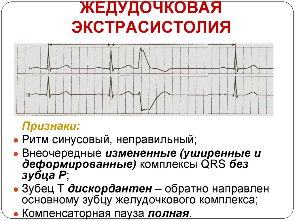 Нарушения проводимости презентация