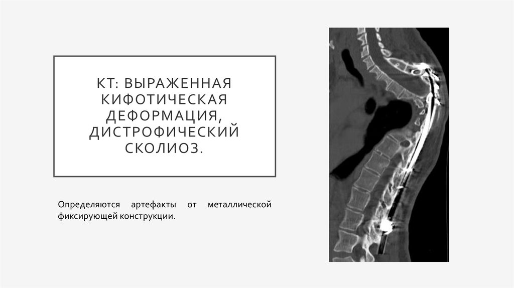 Кифотическая установка шейного отдела