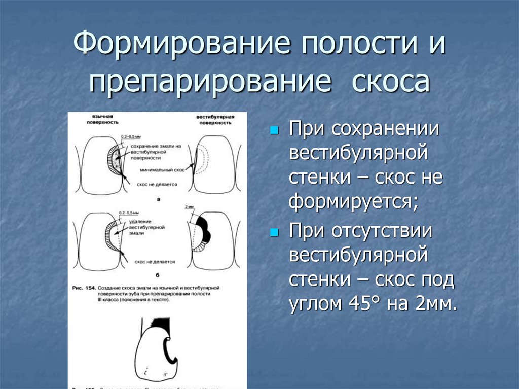 Способы препарирования кариозных полостей