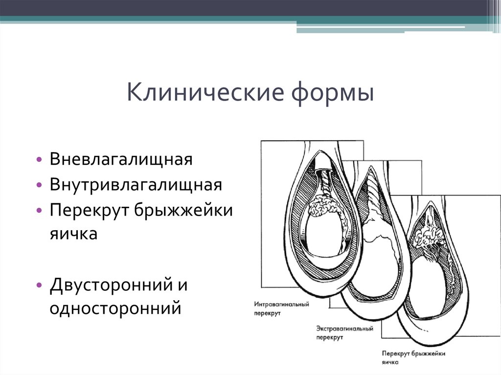 Перекрут яичка карта вызова