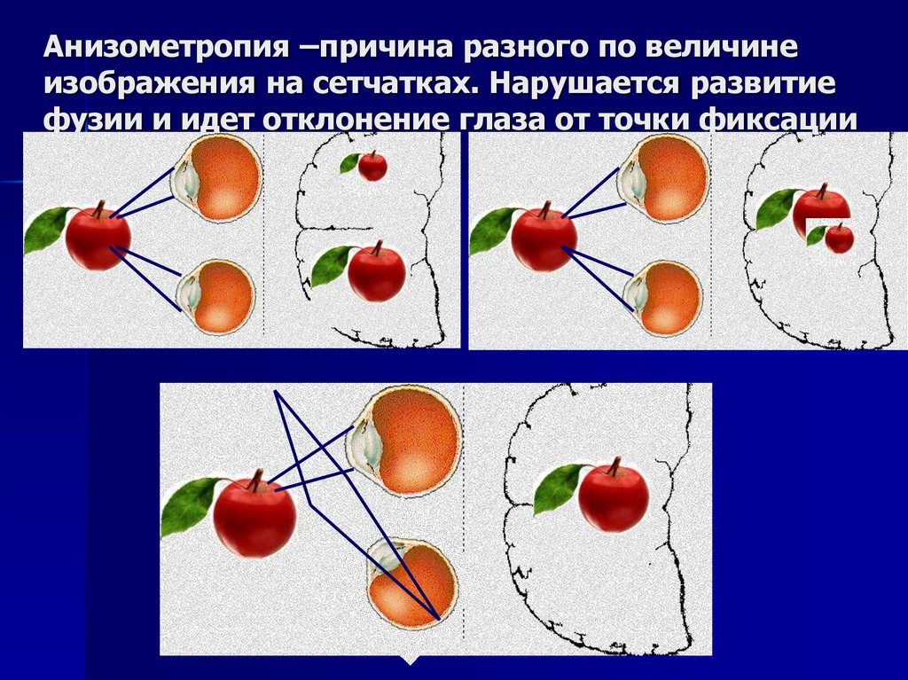 Неравенство величин изображения одного и того же предмета на сетчатке называется