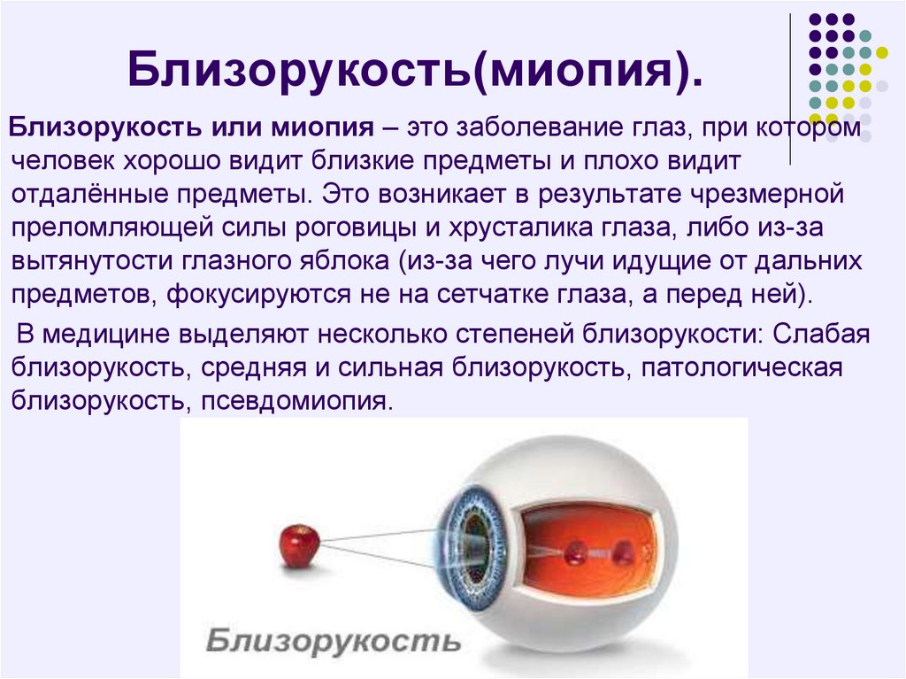 Глазное зрение 1. Миопия. Близорукость миопия. Болезнь глаз близорукость.