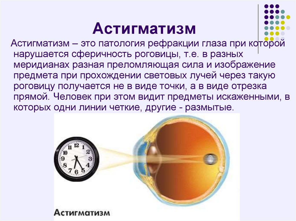 Минус и плюс в зрении. Гдазое заболевание асемаиизм. Болезнь глаз астигматизм. Сложный гиперметропический астигматизм. Астигматизм 2.5 диоптрии.