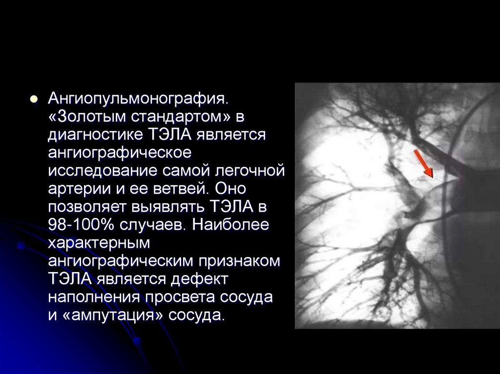 ТЭЛА. Методы инструментального обследования пациентов. Дифференциальный ...