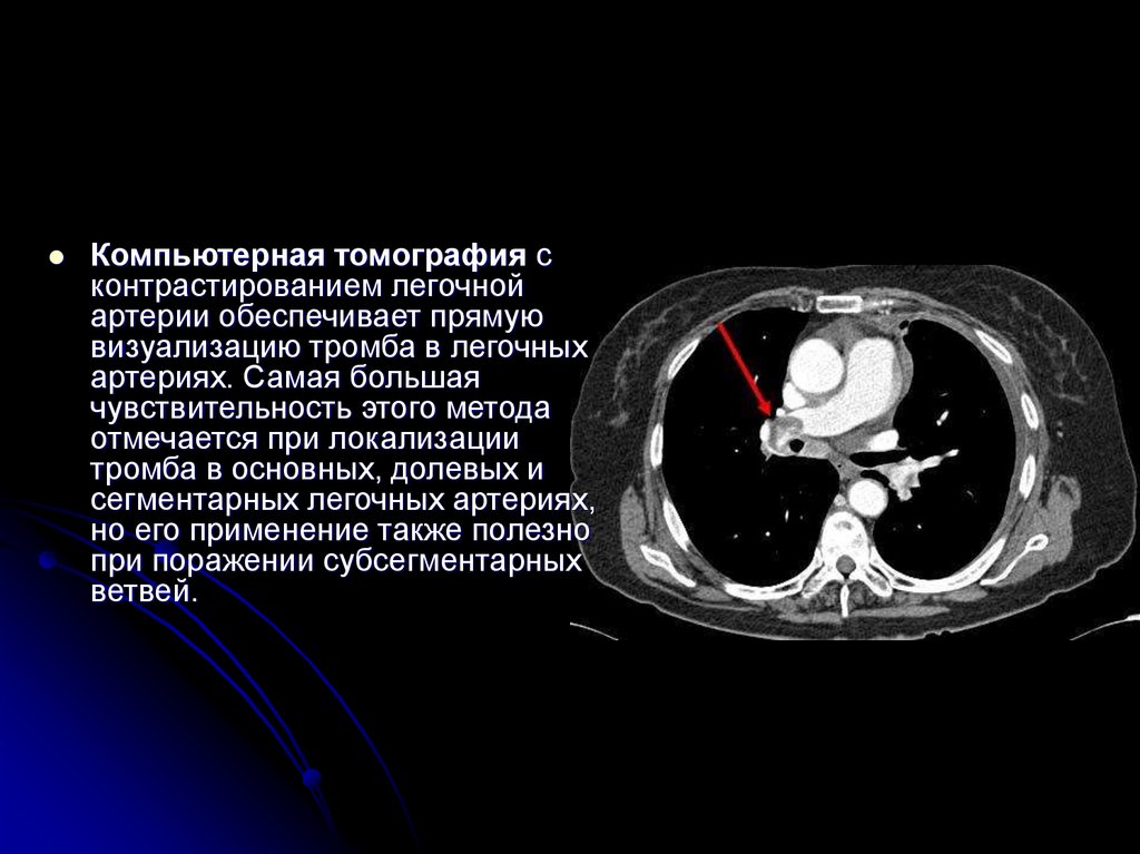 ТЭЛА. Методы инструментального обследования пациентов. Дифференциальный ...