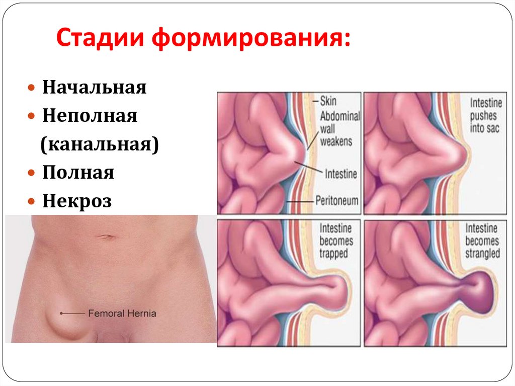 Грыжа У Мужчин Симптомы Фото