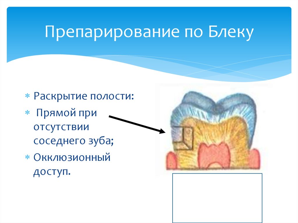 Способы препарирования кариозных полостей