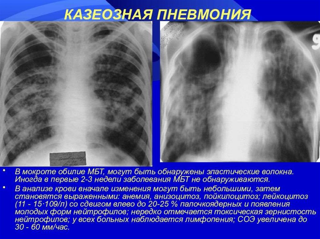 Клинический случай туберкулез. Лобарная казеозная пневмония. Рентгенологическая характеристика казеозной пневмонии. Лобулярная казеозная пневмония рентген. Казеозная пневмония рентген.