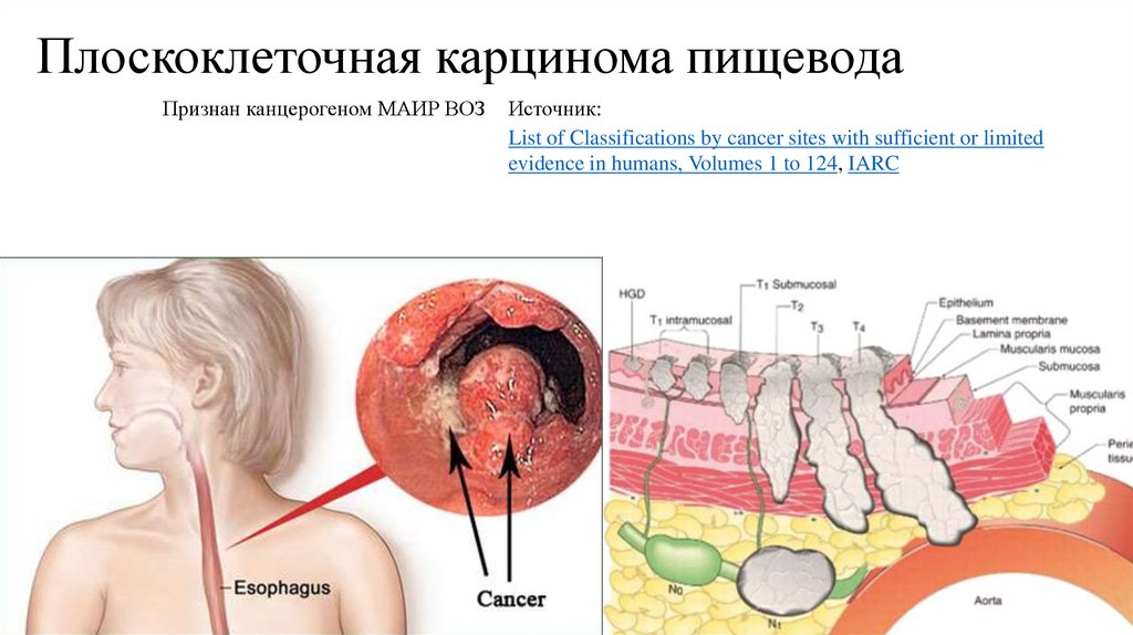 Плоскоклеточная карцинома пищевода