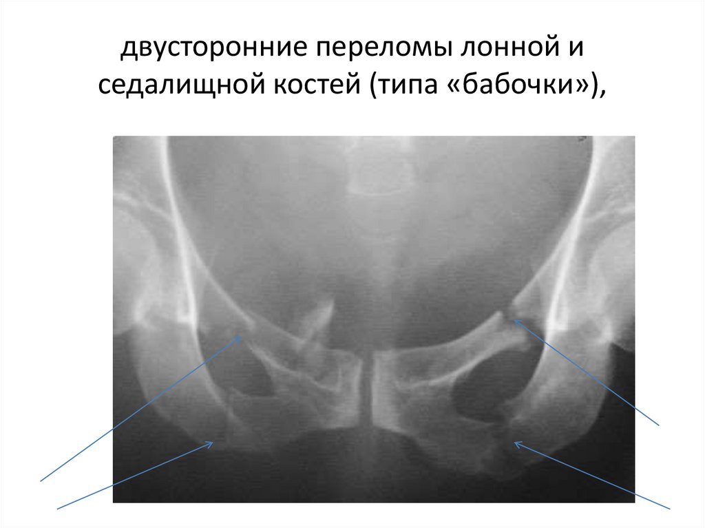 Перелом лонной кости